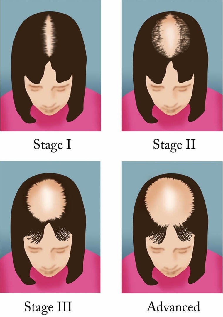 Biotin (H Vitamini)  Eksikliğinin Belirtileri Nelerdir?